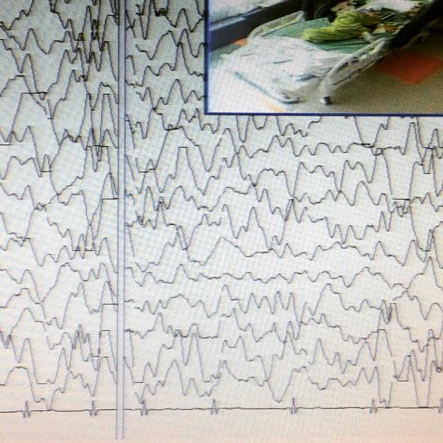 dreaming eeg epilepsy seizure how far we have come